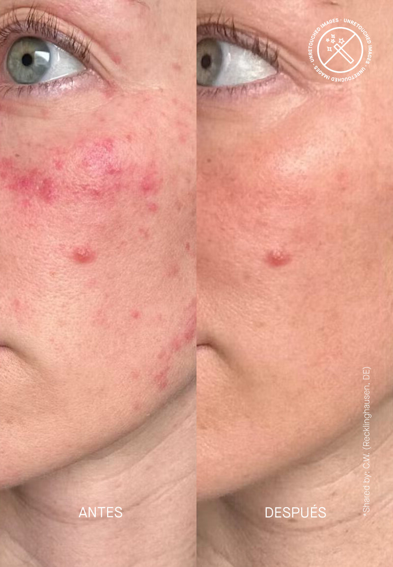 THERAMID Ceramide Treatment