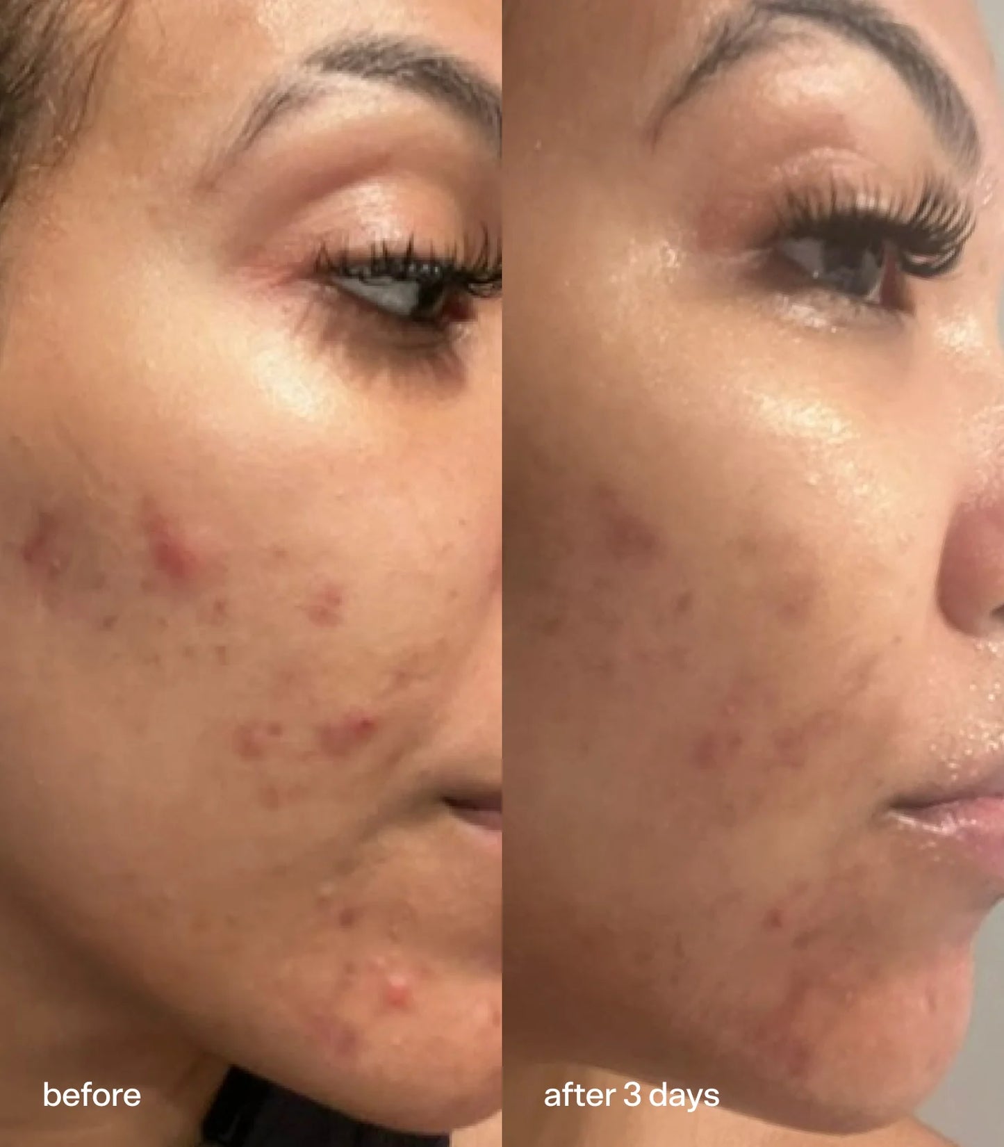 Bubble Super Clear Blemish Prevention Serum 2% Salicylic Acid